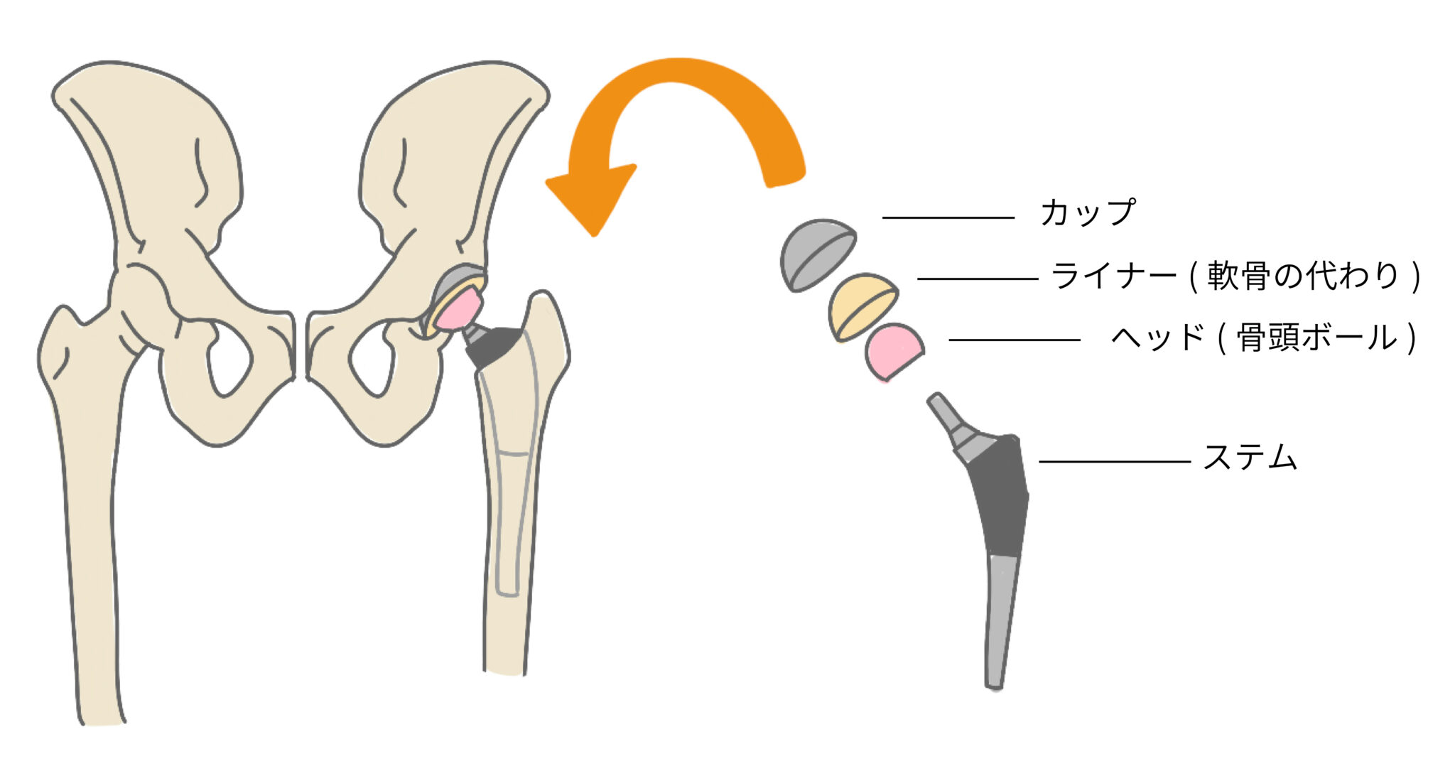 人工股関節置換術とは｜メリットやリスク、術後の生活など専門医が解説